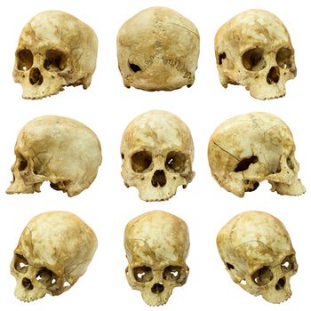 Collection of human skull (Mongoloid) and broken skull