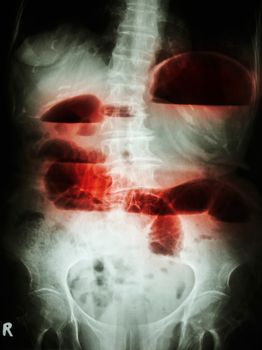 Film X-ray abdomen upright show small bowel dilated and air-fluid level in small bowel due to small bowel obstruction