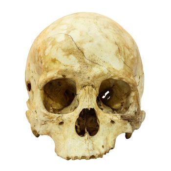 Human Skull Fracture (Mongoloid,Asian) on isolated background