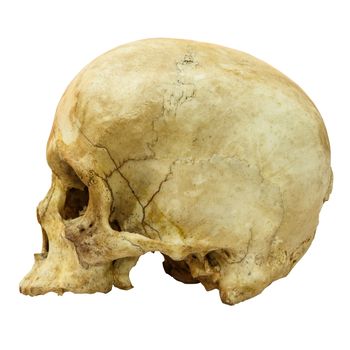 Human Skull Fracture (side) (Mongoloid,Asian) on isolated background