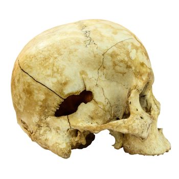 Human Skull Fracture(side) (Mongoloid,Asian) on isolated background
