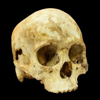 Human Skull Fracture(side) (Mongoloid,Asian) on isolated background