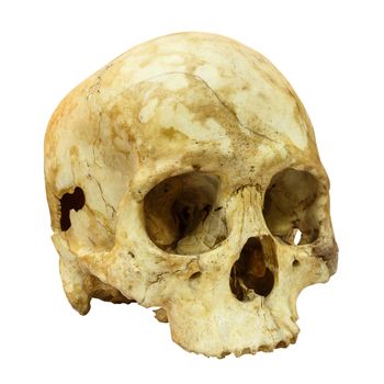 Human Skull Fracture(side) (Mongoloid,Asian) on isolated background