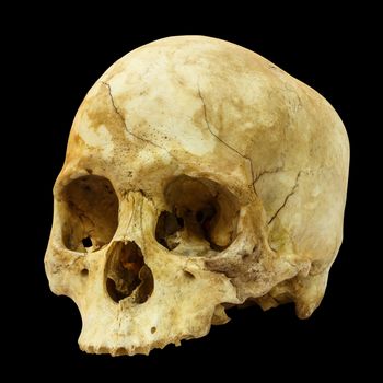 Human Skull Fracture(side) (Mongoloid,Asian) on isolated background