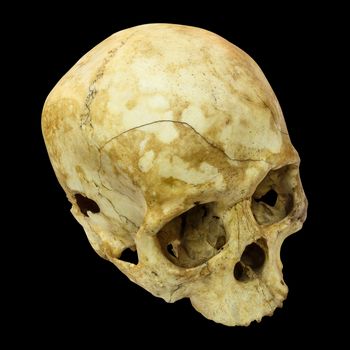 Human Skull Fracture(top side,apex)(Mongoloid,Asian) on isolated background