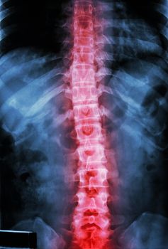 film x-ray T-L spine(Thoracic-Lumbar spine) show : human's thoracic-lumbar spine and inflammation at spine