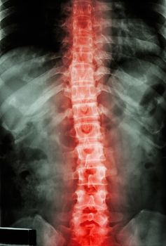 film x-ray T-L spine(Thoracic-Lumbar spine) show : human's thoracic-lumbar spine and inflammation at spine