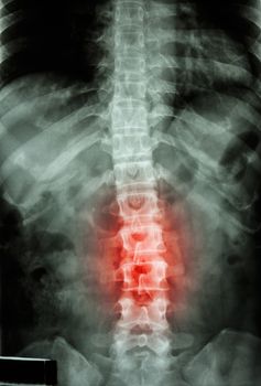 film x-ray T-L spine(Thoracic-Lumbar spine) show : human's thoracic-lumbar spine and inflammation at lumbar spine