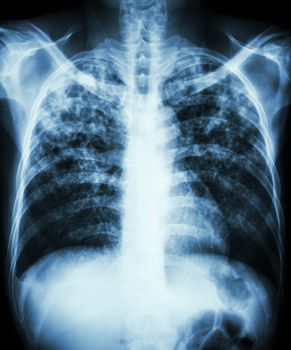 "Pulmonary tuberculosis" Film chest x-ray show interstitial infiltration both lung due to mycobacterium tuberculosis infection