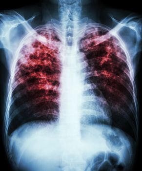 "Pulmonary tuberculosis" Film chest x-ray show interstitial infiltration both lung due to mycobacterium tuberculosis infection