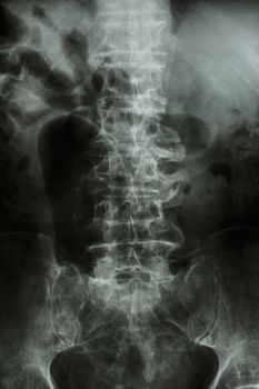 "Spondylosis" Film x-ray : lumbar spine with spur & collapse at body of spine