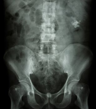 Left kidney stone(opaque area at right upper of image) and bladder stone(opaque area at lower of image)