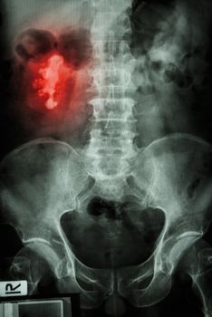 film x-ray show right renal calculi (staghorn)