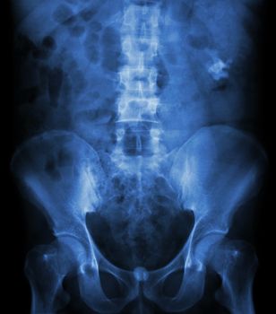 Left kidney stone(opaque area at right upper of image) and bladder stone(opaque area at lower of image)