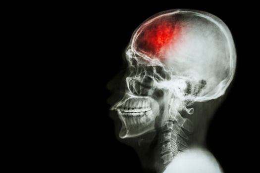 "Stroke" (cerebrovascular accident). Film x-ray skull lateral with stroke and blank area at left side