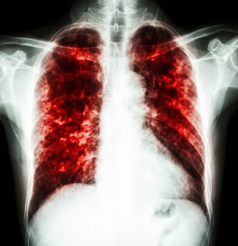 film chest x-ray show interstitial infiltrate both lung due to Mycobacterium tuberculosis infection (Pulmonary Tuberculosis)