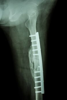 Fracture shaft of femur. It was operated and internal fixation by plate & screw
