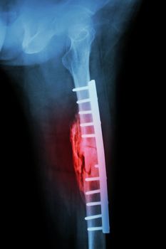 Fracture shaft of femur. It was operated and internal fixation by plate & screw