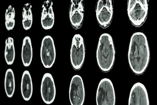 film CT scan of brain show ischemic stroke and hemorrhagic stroke
