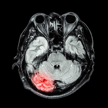 MRI brain : show lower part of brain(cerebellum,temporal lobe of cerebrum,brain stem,eye,ethmoid sinus,structure of cranium)