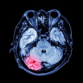 MRI brain : show lower part of brain(cerebellum,temporal lobe of cerebrum,brain stem,eye,ethmoid sinus,structure of cranium)