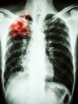 film chest x-ray show cavity at right upper lung due to Mycobacterium tuberculosis infection (Pulmonary Tuberculosis)