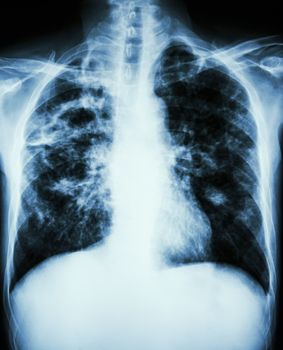 film chest x-ray show cavity at right lung,fibrosis & interstitial & patchy infiltrate at both lung due to Mycobacterium tuberculosis infection (Pulmonary Tuberculosis)