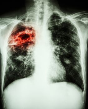 film chest x-ray show cavity at right lung,fibrosis & interstitial & patchy infiltrate at both lung due to Mycobacterium tuberculosis infection (Pulmonary Tuberculosis)