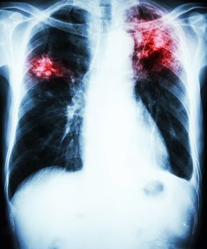 film chest x-ray show alveolar infiltrate at left upper lung and right middle lung due to Mycobacterium tuberculosis infection (Pulmonary Tuberculosis)