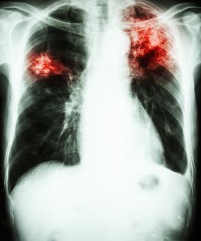 film chest x-ray show alveolar infiltrate at left upper lung and right middle lung due to Mycobacterium tuberculosis infection (Pulmonary Tuberculosis)
