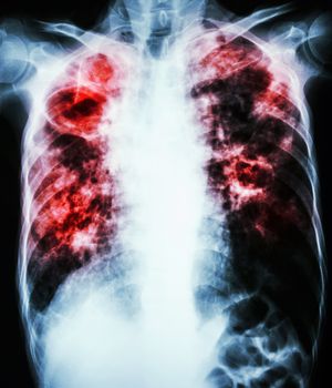 film chest x-ray show cavity at right lung,fibrosis & interstitial & patchy infiltrate at both lung due to Mycobacterium tuberculosis infection (Pulmonary Tuberculosis)