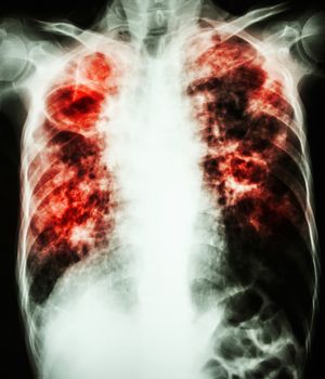 film chest x-ray show cavity at right lung,fibrosis & interstitial & patchy infiltrate at both lung due to Mycobacterium tuberculosis infection (Pulmonary Tuberculosis)