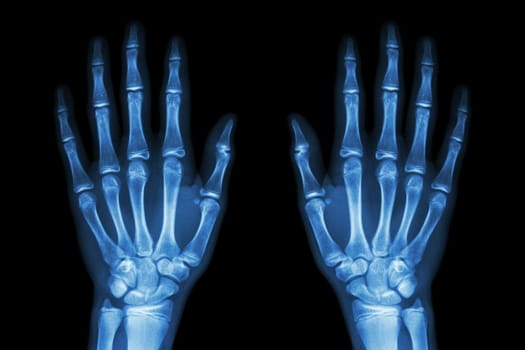 X-ray normal human hands (front) on black background