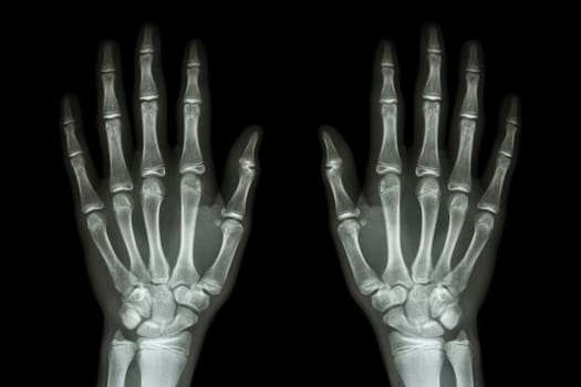 X-ray normal human hands (front) on black background