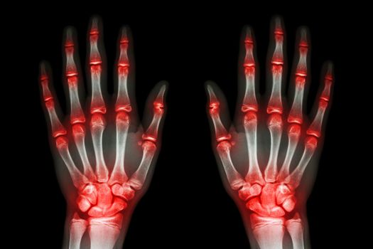 multiple joint arthritis both hands ( Gout , Rheumatoid ) on black background