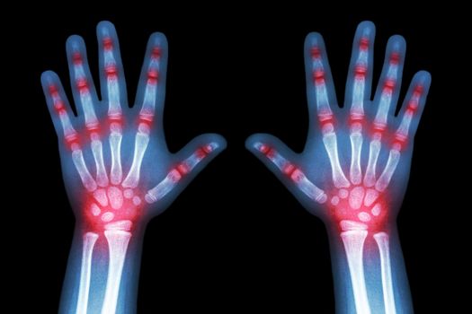 Rheumatoid arthritis ( X-ray both child hands and multiple joint arthritis )