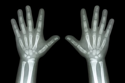 X-ray both child hands on black background