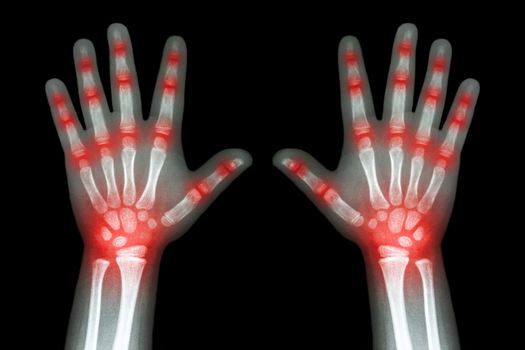 Rheumatoid arthritis ( X-ray both child hands and multiple joint arthritis )