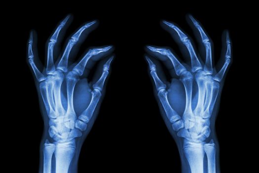 X-ray normal human hands (front) on black background