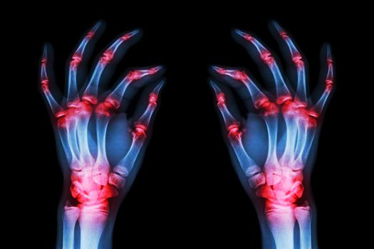 multiple joint arthritis both adult hands ( Gout , Rheumatoid ) on black background