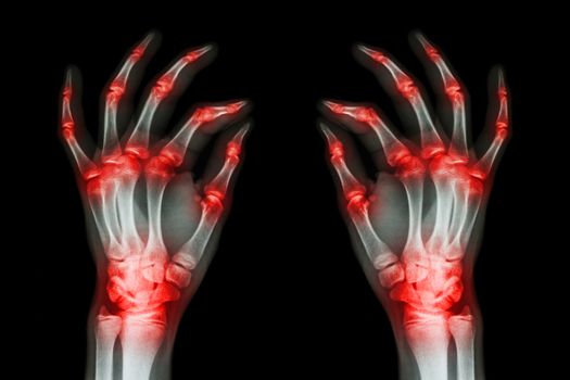 multiple joint arthritis both adult hands ( Gout , Rheumatoid ) on black background