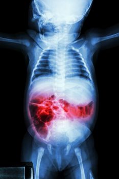 Enteritis (X-ray of sick infant and inflammation of intestine)