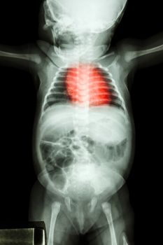 film x-ray whole infant's body : show normal infant's body