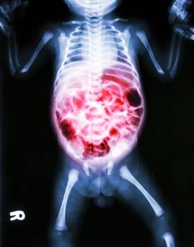 Enteritis (X-ray of sick infant and inflammation of intestine)