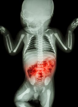 Enteritis (X-ray of sick infant and inflammation of intestine)