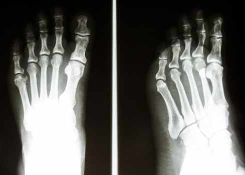 film X-ray show normal bone of human's foot