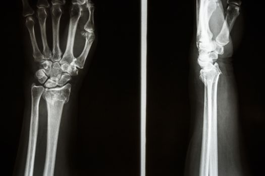 Film X-ray show fracture distal radius (Colles' fracture) (Wrist)