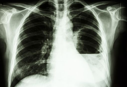 film X-ray show left lung abscess from Burkholderia pseudomallei infection (Mellioidosis)