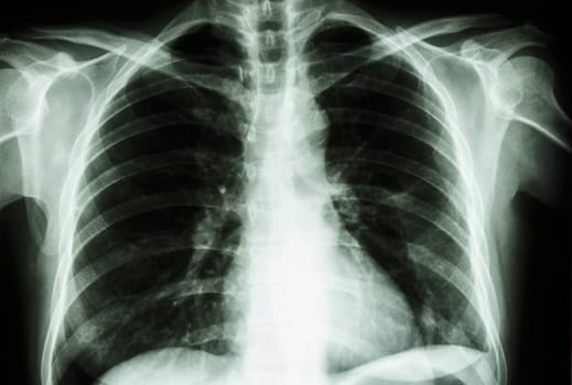 film X-ray show normal human's chest (bone and internal organ)