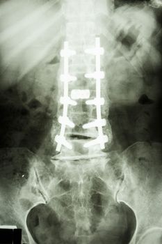 film X-ray show lumbar spine with pedicle screw fixation in spondylolithesis patient